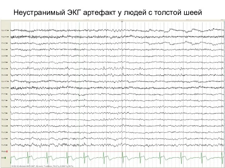 Неустранимый ЭКГ артефакт у людей с толстой шеей