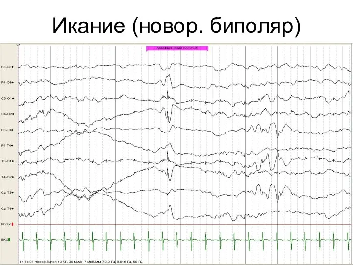 Икание (новор. биполяр)