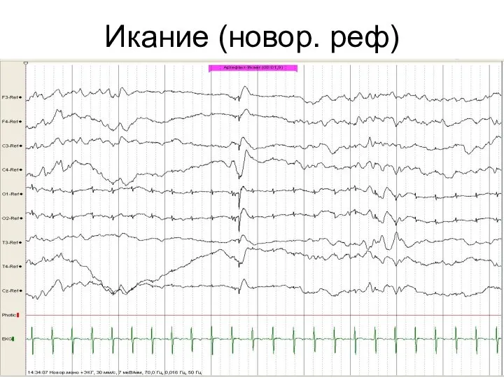 Икание (новор. реф)