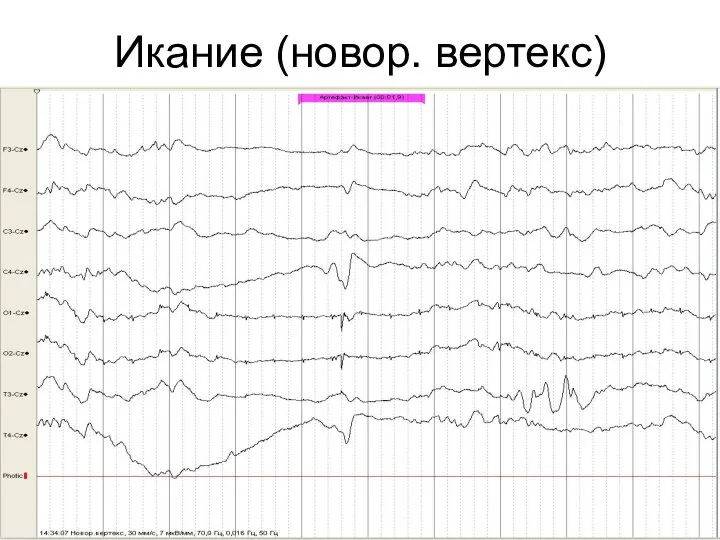 Икание (новор. вертекс)