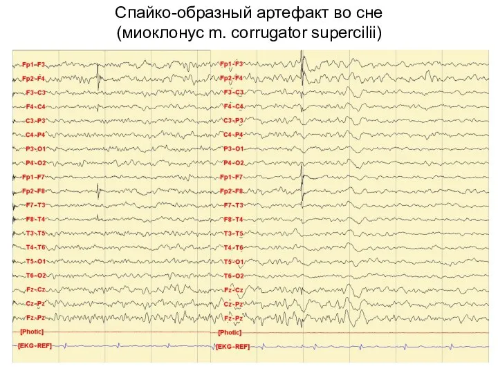 Спайко-образный артефакт во сне (миоклонус m. corrugator supercilii)