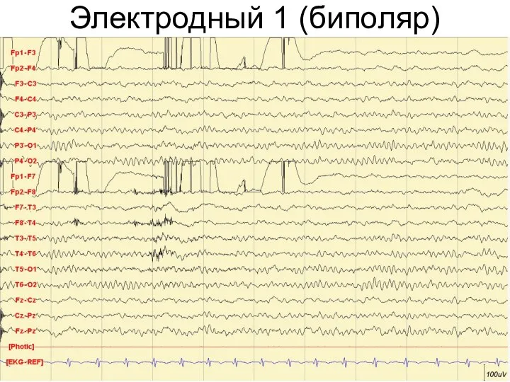 Электродный 1 (биполяр)