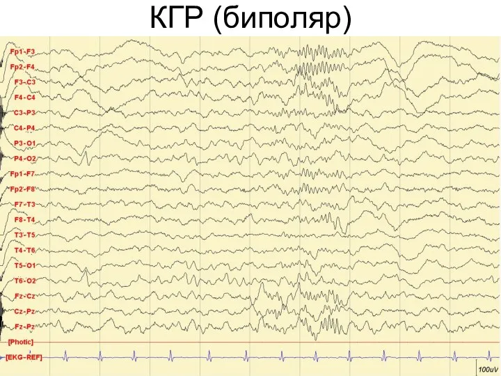 КГР (биполяр)