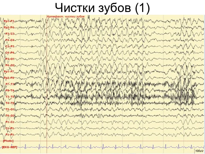 Чистки зубов (1)