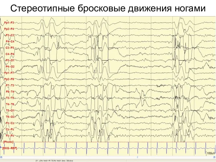 Стереотипные бросковые движения ногами