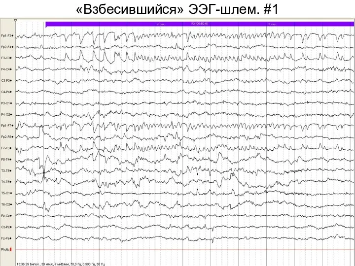 «Взбесившийся» ЭЭГ-шлем. #1