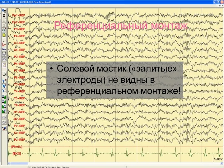 Солевой мостик («залитые» электроды) не видны в референциальном монтаже! Референциальный монтаж