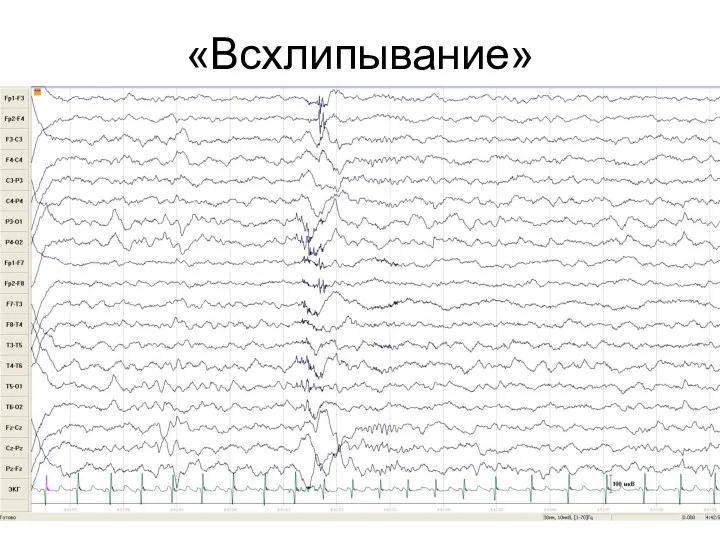 «Всхлипывание»