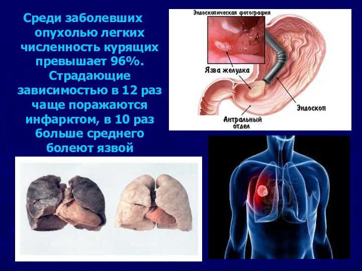 Среди заболевших опухолью легких численность курящих превышает 96%. Страдающие зависимостью в