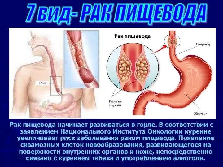 Рак пищевода начинает развиваться в горле. В соответствии с заявлением Национального