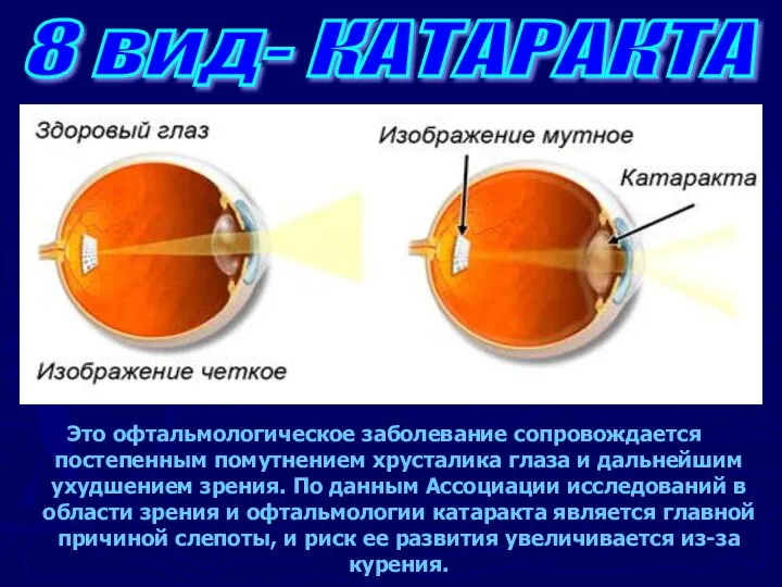 Это офтальмологическое заболевание сопровождается постепенным помутнением хрусталика глаза и дальнейшим ухудшением