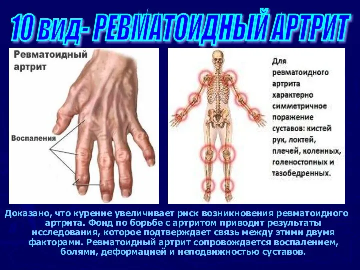 Доказано, что курение увеличивает риск возникновения ревматоидного артрита. Фонд по борьбе