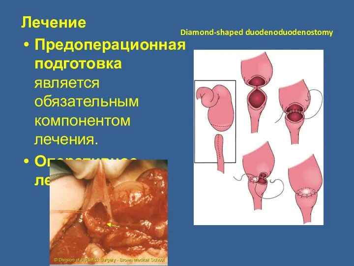 Лечение Предоперационная подготовка является обязательным компонентом лечения. Оперативное лечение Diamond-shaped duodenoduodenostomy