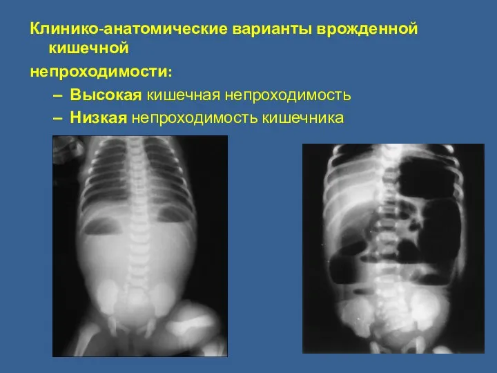 Клинико-анатомические варианты врожденной кишечной непроходимости: Высокая кишечная непроходимость Низкая непроходимость кишечника