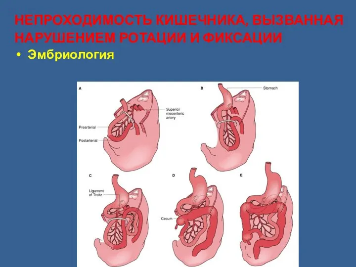 НЕПРОХОДИМОСТЬ КИШЕЧНИКА, ВЫЗВАННАЯ НАРУШЕНИЕМ РОТАЦИИ И ФИКСАЦИИ Эмбриология