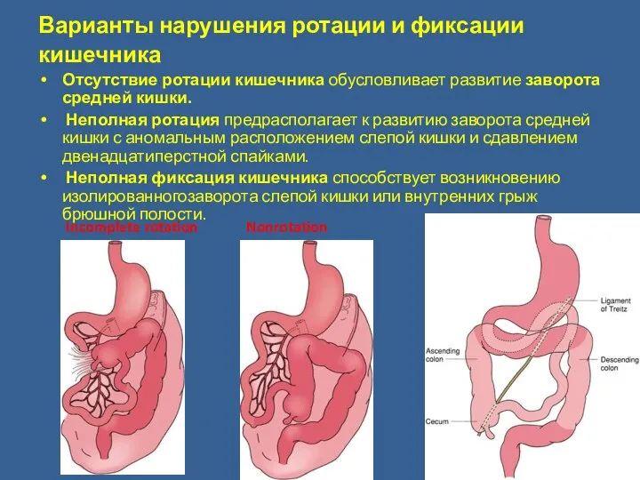 Варианты нарушения ротации и фиксации кишечника Отсутствие ротации кишечника обусловливает развитие