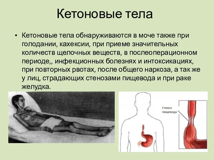 Кетоновые тела обнаруживаются в моче также при голодании, кахексии, при приеме