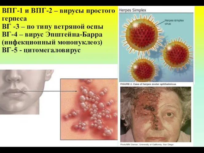 ВПГ-1 и ВПГ-2 – вирусы простого герпеса ВГ -3 – по