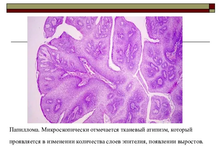 Папиллома. Микроскопически отмечается тканевый атипизм, который проявляется в изменении количества слоев эпителия, появлении выростов.