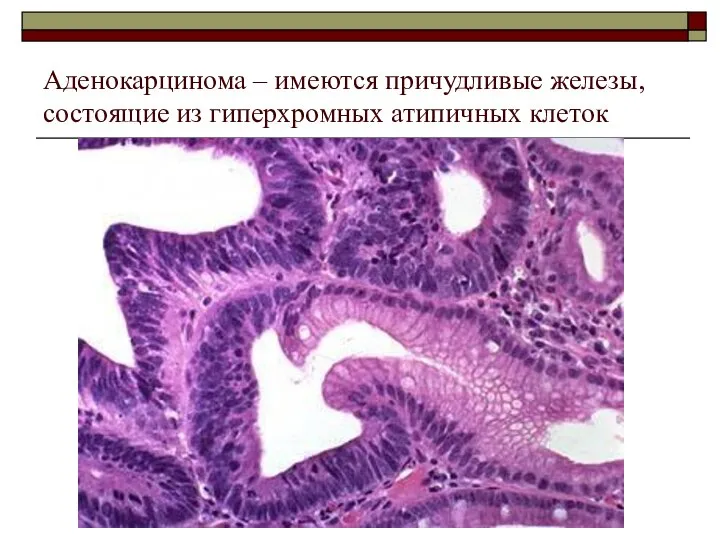 Аденокарцинома – имеются причудливые железы, состоящие из гиперхромных атипичных клеток