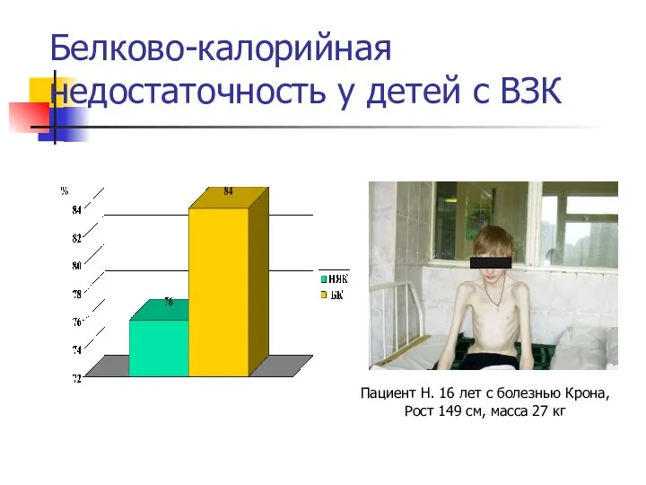 Белково-калорийная недостаточность у детей с ВЗК Пациент Н. 16 лет с