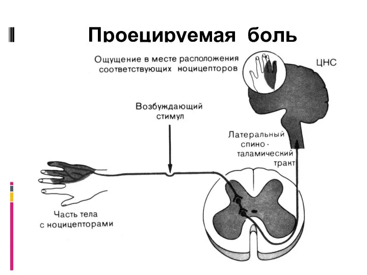 Проецируемая боль