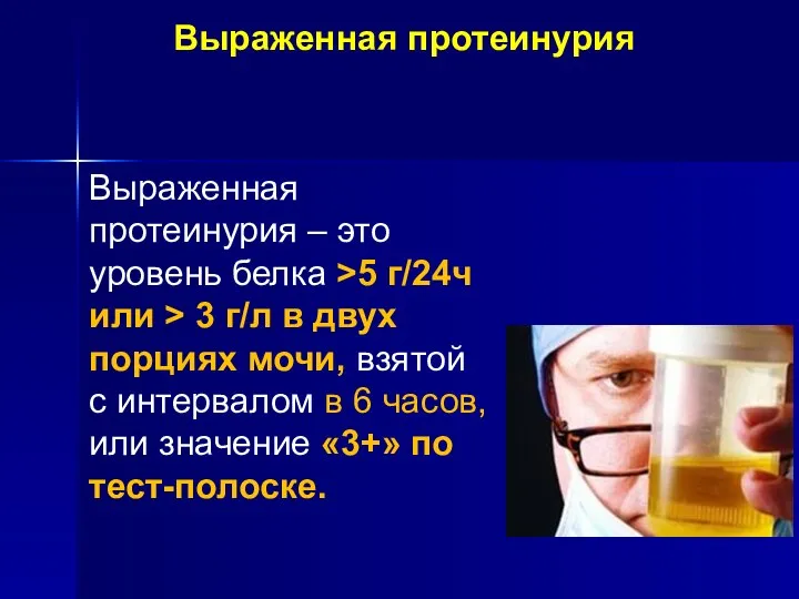 Выраженная протеинурия Выраженная протеинурия – это уровень белка >5 г/24ч или