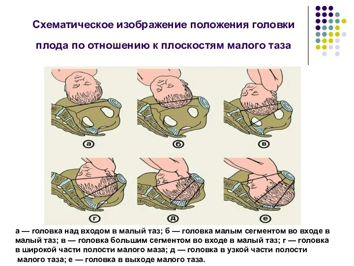 Схематическое изображение положения головки плода по отношению к плоскостям малого таза