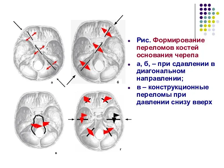 Рис. Формирование переломов костей основания черепа а, б, – при сдавлении