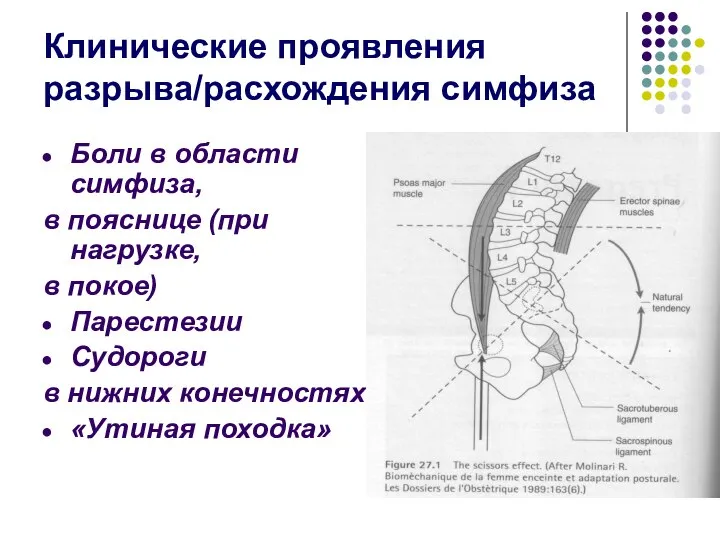 Клинические проявления разрыва/расхождения симфиза Боли в области симфиза, в пояснице (при