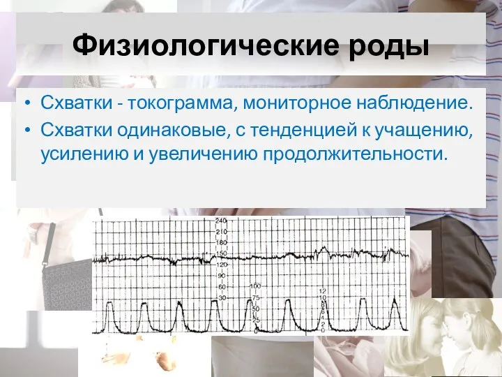 Физиологические роды Схватки - токограмма, мониторное наблюдение. Схватки одинаковые, с тенденцией