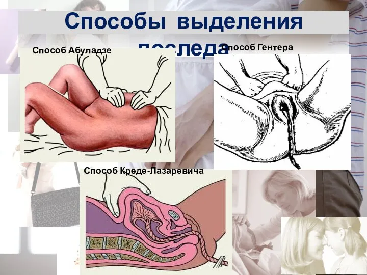 Способы выделения последа Способ Абуладзе Способ Креде-Лазаревича Способ Гентера