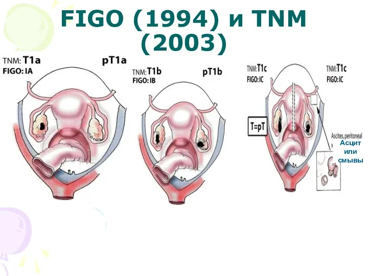 FIGO (1994) и TNM (2003)