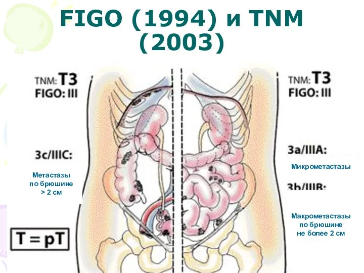 FIGO (1994) и TNM (2003)