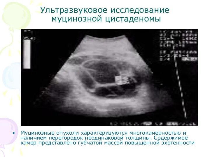 Ультразвуковое исследование муцинозной цистаденомы Муцинозные опухоли характеризуются многокамерностью и наличием перегородок