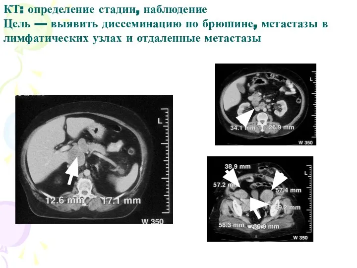 КТ: определение стадии, наблюдение Цель — выявить диссеминацию по брюшине, метастазы