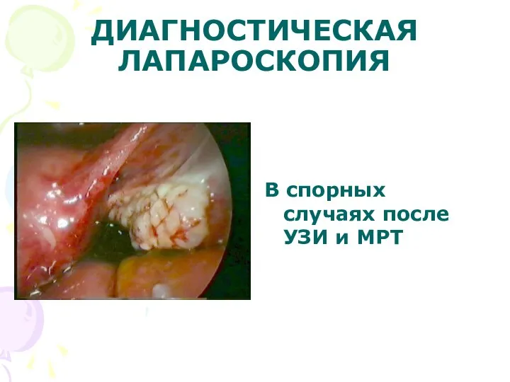 ДИАГНОСТИЧЕСКАЯ ЛАПАРОСКОПИЯ В спорных случаях после УЗИ и МРТ