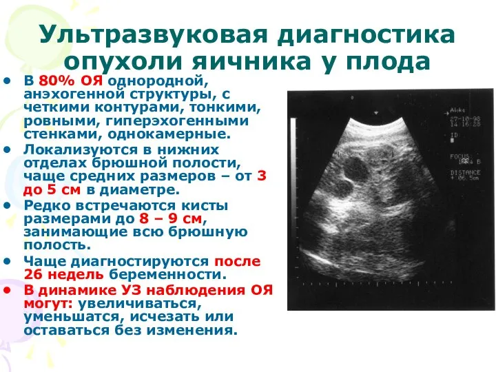 Ультразвуковая диагностика опухоли яичника у плода В 80% ОЯ однородной, анэхогенной