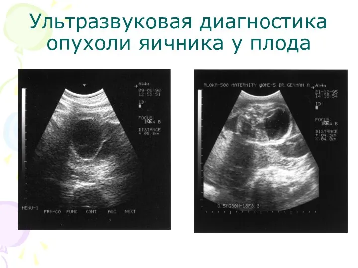 Ультразвуковая диагностика опухоли яичника у плода