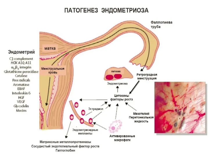 ПАТОГЕНЕЗ ЭНДОМЕТРИОЗА