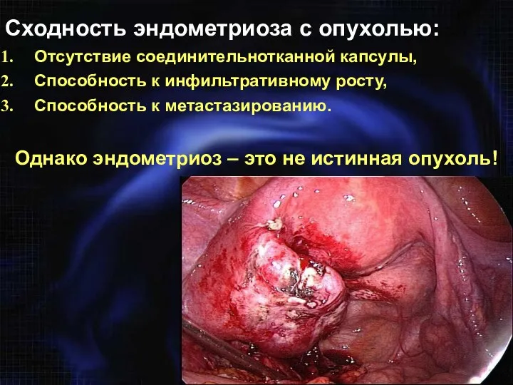 Сходность эндометриоза с опухолью: Отсутствие соединительнотканной капсулы, Способность к инфильтративному росту,