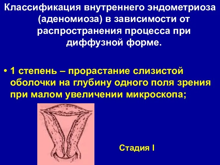 Классификация внутреннего эндометриоза (аденомиоза) в зависимости от распространения процесса при диффузной