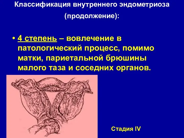 Классификация внутреннего эндометриоза (продолжение): 4 степень – вовлечение в патологический процесс,