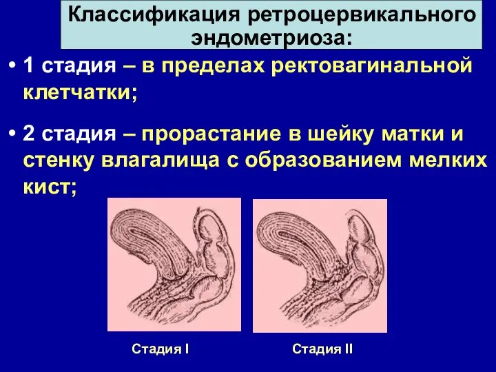 1 стадия – в пределах ректовагинальной клетчатки; 2 стадия – прорастание