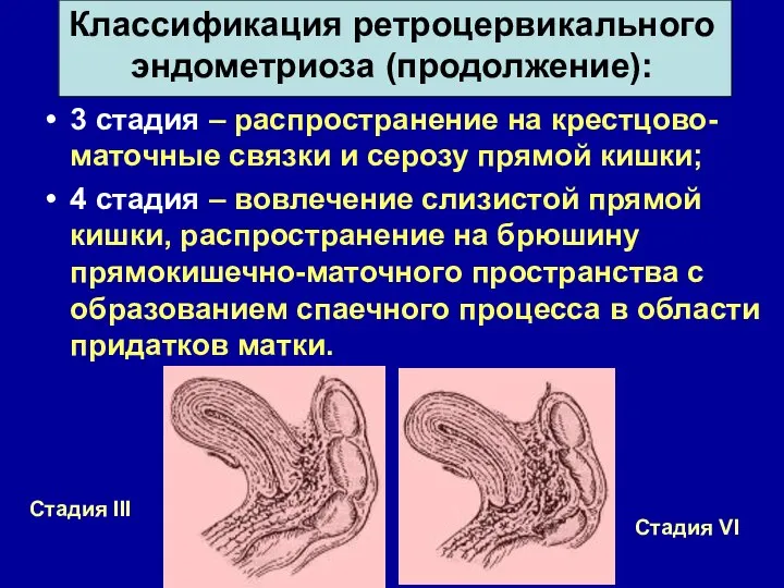 Классификация ретроцервикального эндометриоза (продолжение): 3 стадия – распространение на крестцово-маточные связки