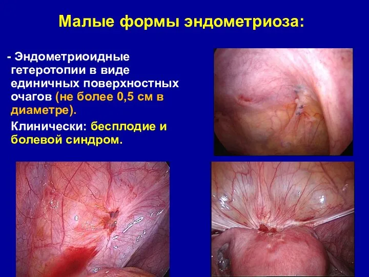 Малые формы эндометриоза: Эндометриоидные гетеротопии в виде единичных поверхностных очагов (не