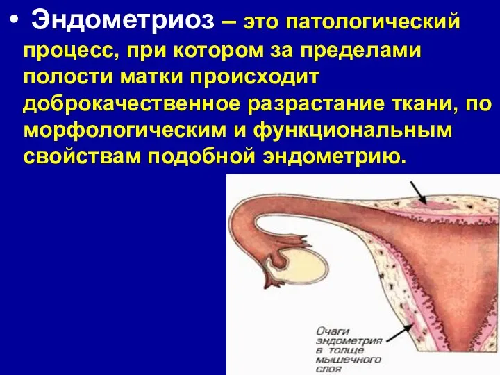 Эндометриоз – это патологический процесс, при котором за пределами полости матки