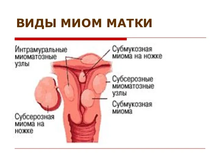 ВИДЫ МИОМ МАТКИ