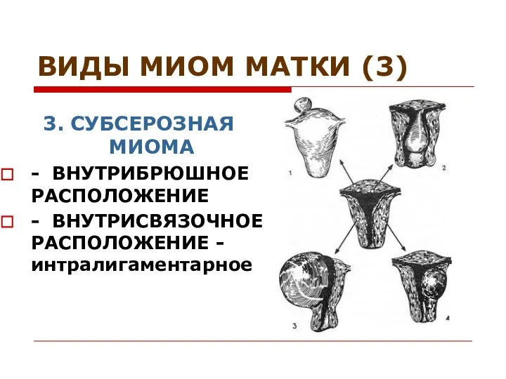 ВИДЫ МИОМ МАТКИ (3) 3. СУБСЕРОЗНАЯ МИОМА - ВНУТРИБРЮШНОЕ РАСПОЛОЖЕНИЕ - ВНУТРИСВЯЗОЧНОЕ РАСПОЛОЖЕНИЕ -интралигаментарное