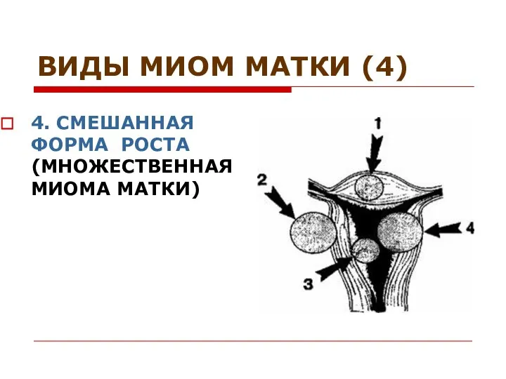 ВИДЫ МИОМ МАТКИ (4) 4. СМЕШАННАЯ ФОРМА РОСТА (МНОЖЕСТВЕННАЯ МИОМА МАТКИ)